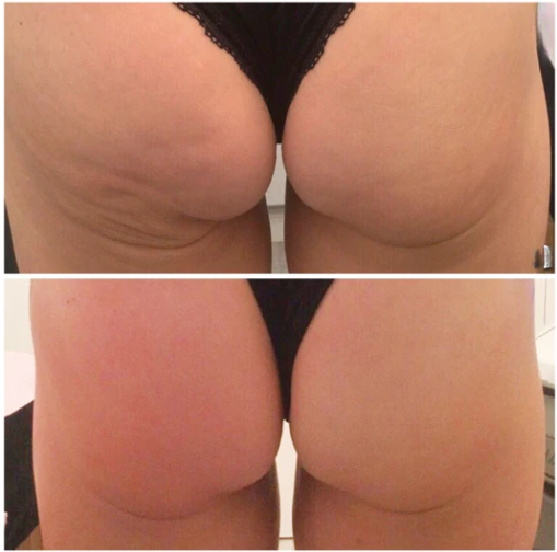 Artemis T Shape 2