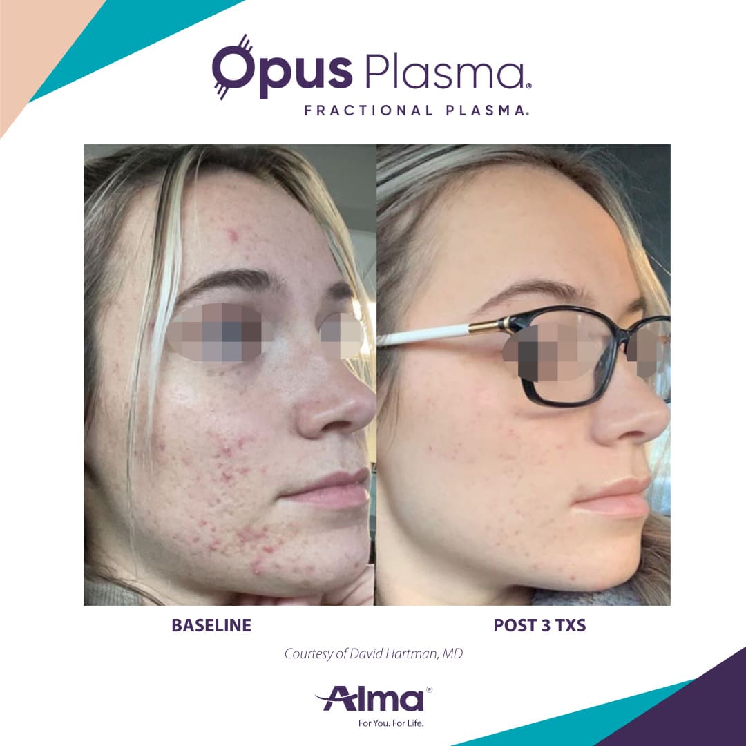 Alma Opus™ Plasma Skin Resurfacing