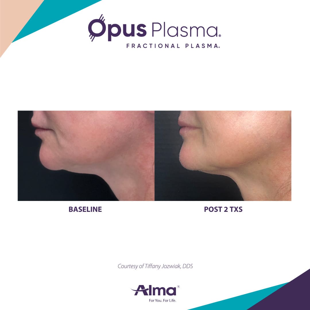 Alma Opus™ Plasma Skin Resurfacing