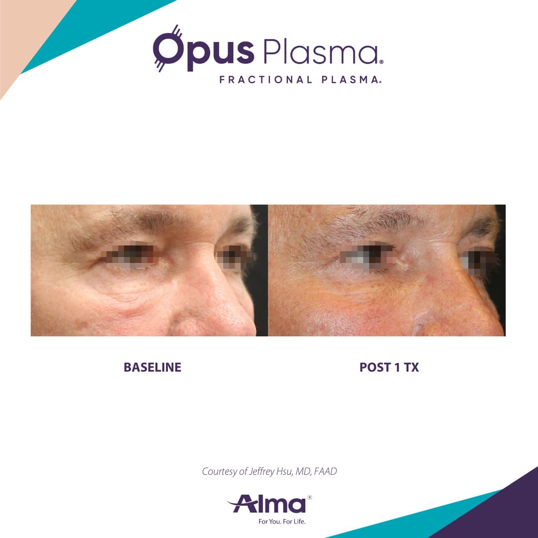 Alma Opus™ Plasma Skin Resurfacing