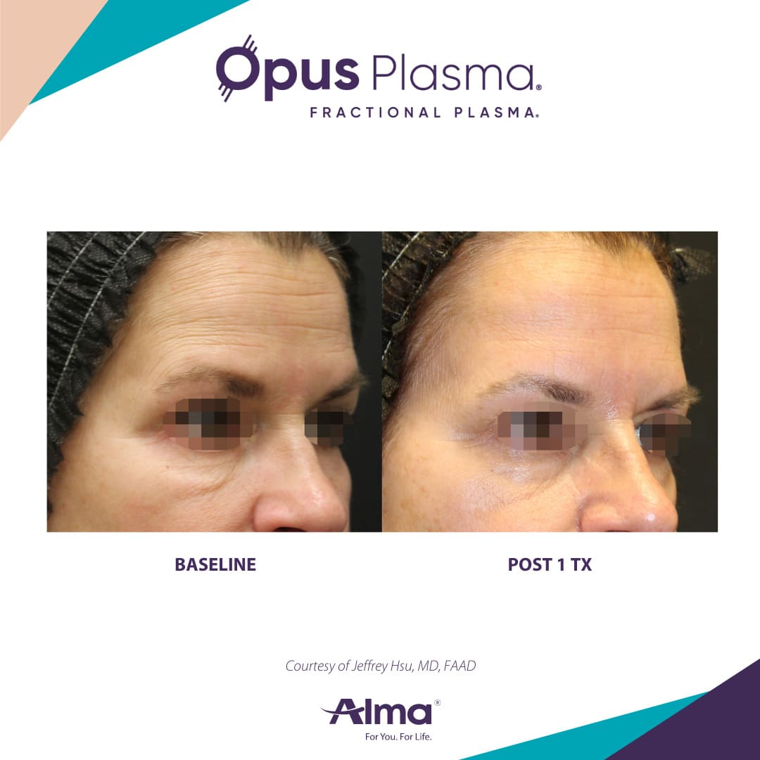 Alma Opus™ Plasma Skin Resurfacing