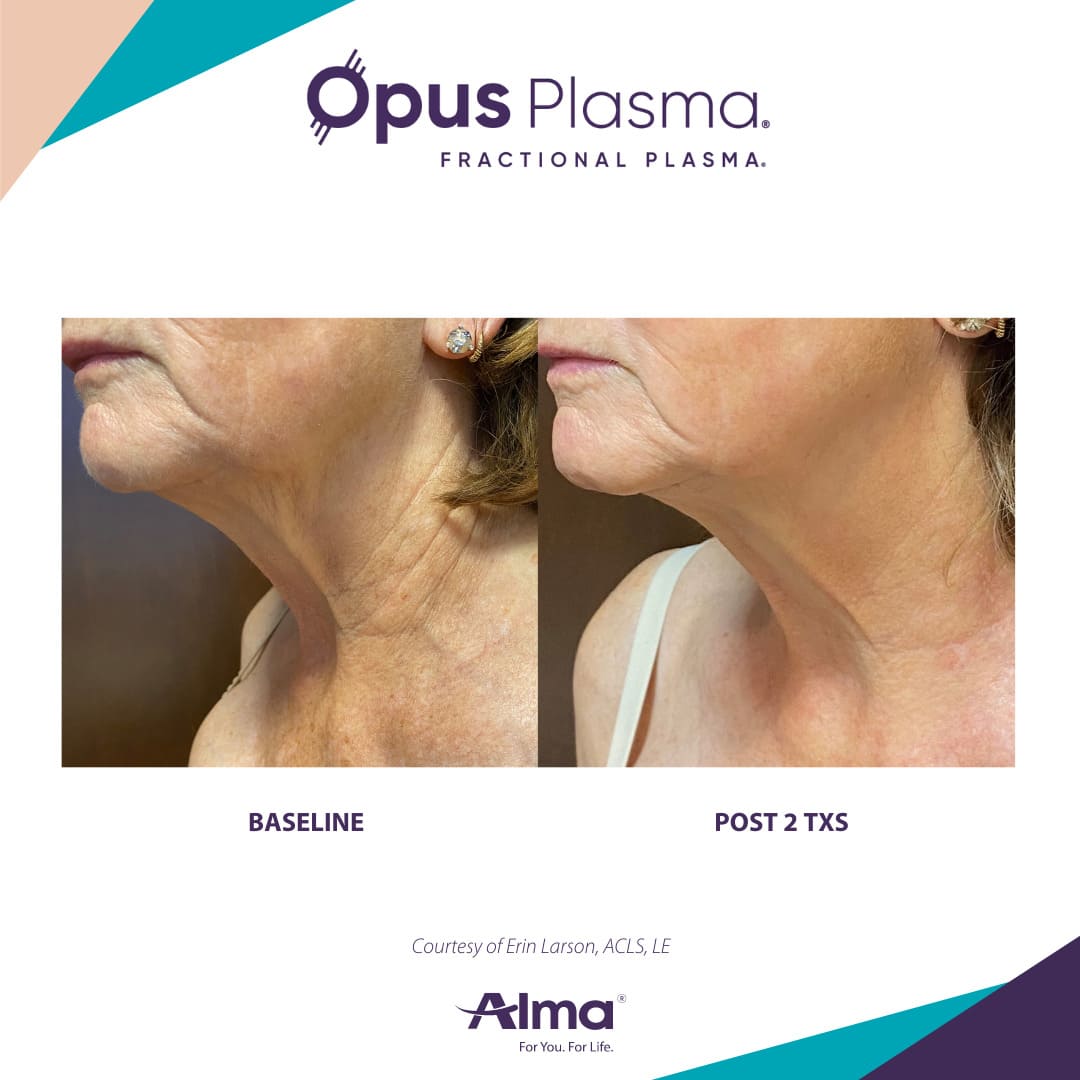 Alma Opus™ Plasma Skin Resurfacing