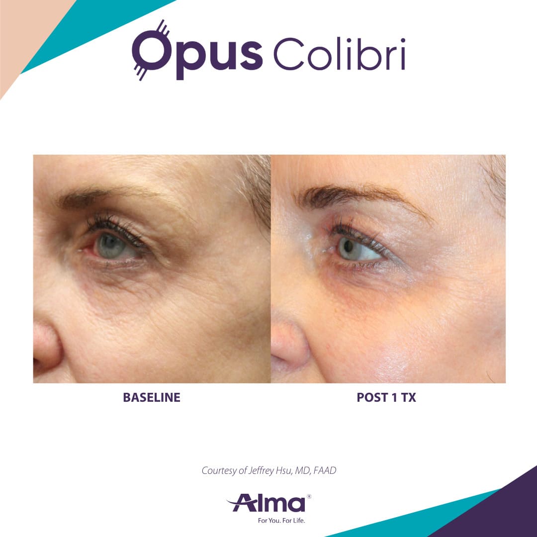 Alma Opus™ Plasma Skin Resurfacing