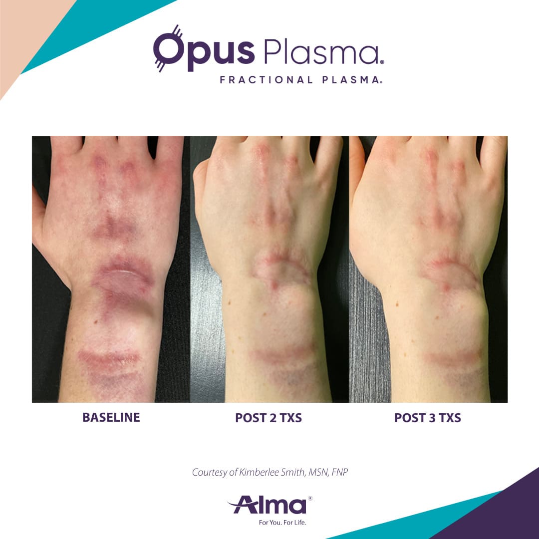 Alma Opus™ Plasma Skin Resurfacing