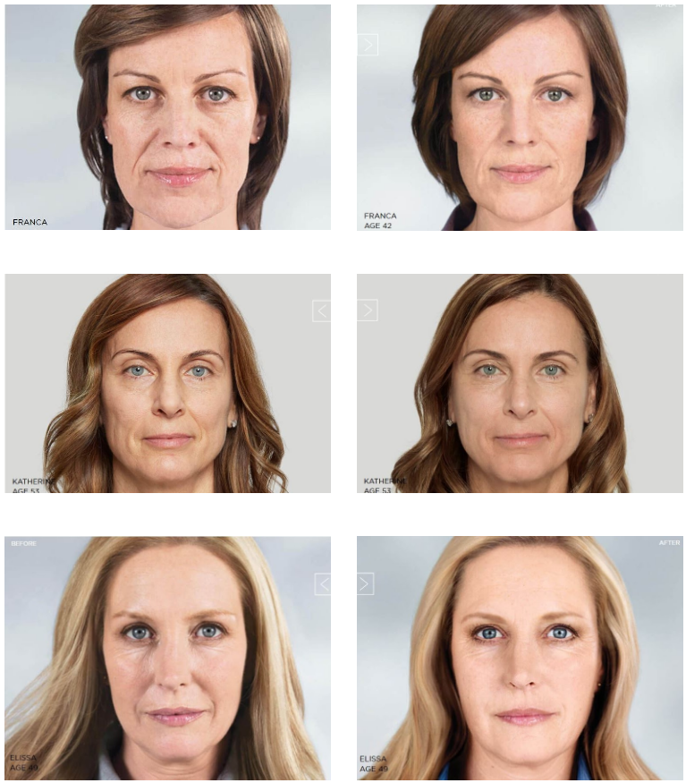Sculptra/Radiesse